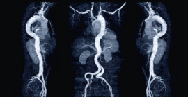 Endovaskuläre Gefäßchirurgie